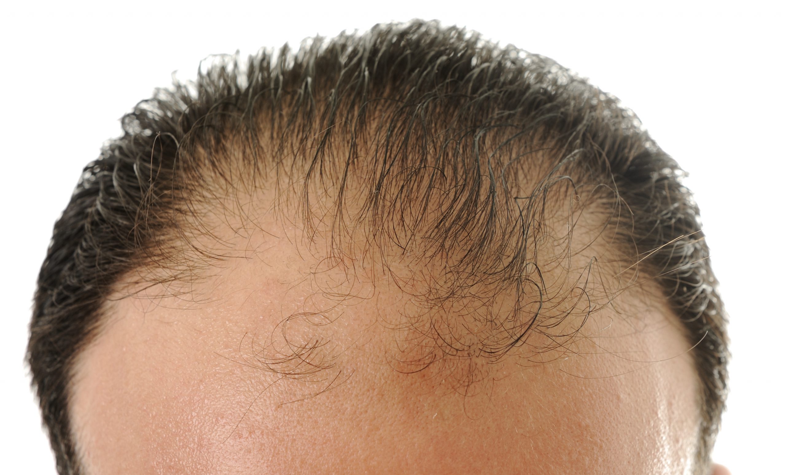 Причины выпадения волос у подростка. Андрогенетическая и андрогенная алопеция. Очаговая алопеция (alopecia Areata). Андрогенная алопеция алопеция.
